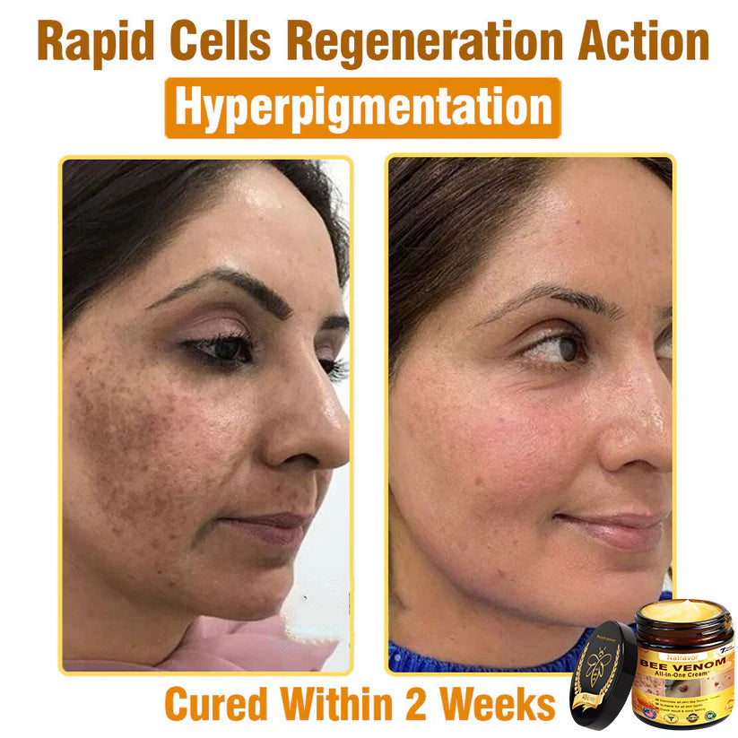 Natravor™ 𝐁𝐞𝐞 𝐕𝐞𝐧𝐨𝐦 𝐀𝐥𝐥-𝐢𝐧-𝐎𝐧𝐞 𝐂𝐫𝐞𝐚𝐦–🌸 Anti-aging,Hydrating, Skin Repair, Even Tone, Acne and Dark Spot Treatment, Wart and Mole Removal, Psoriasis Relief