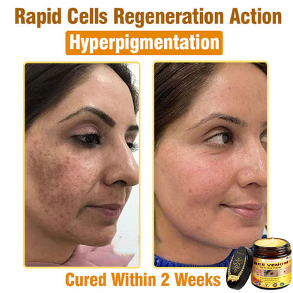 Natravor™ 𝐁𝐞𝐞 𝐕𝐞𝐧𝐨𝐦 𝐀𝐥𝐥-𝐢𝐧-𝐎𝐧𝐞 𝐂𝐫𝐞𝐚𝐦–🌸 Anti-aging,Hydrating, Skin Repair, Even Tone, Acne and Dark Spot Treatment, Wart and Mole Removal, Psoriasis Relief
