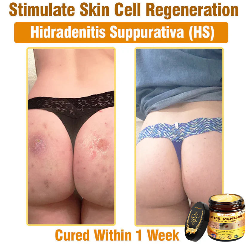 Natravor™ 𝐁𝐞𝐞 𝐕𝐞𝐧𝐨𝐦 𝐀𝐥𝐥-𝐢𝐧-𝐎𝐧𝐞 𝐂𝐫𝐞𝐚𝐦–🌸 Anti-aging,Hydrating, Skin Repair, Even Tone, Acne and Dark Spot Treatment, Wart and Mole Removal, Psoriasis Relief