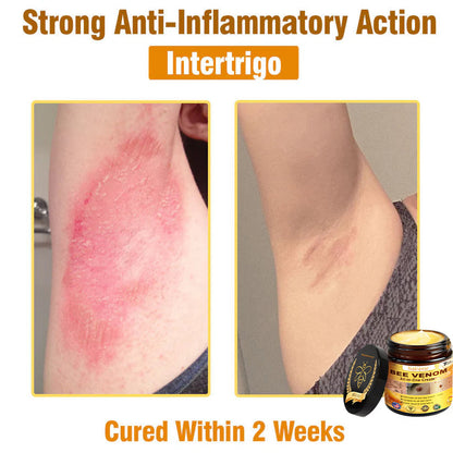 Natravor™ 𝐁𝐞𝐞 𝐕𝐞𝐧𝐨𝐦 𝐀𝐥𝐥-𝐢𝐧-𝐎𝐧𝐞 𝐂𝐫𝐞𝐚𝐦–🌸 Anti-aging,Hydrating, Skin Repair, Even Tone, Acne and Dark Spot Treatment, Wart and Mole Removal, Psoriasis Relief