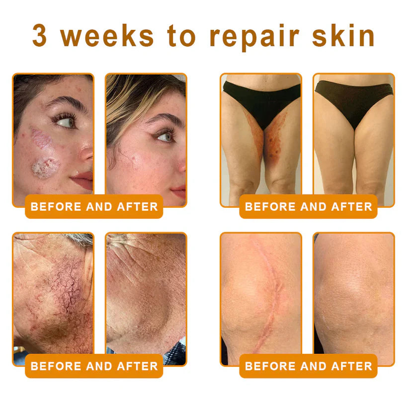 Natravor™ 𝐁𝐞𝐞 𝐕𝐞𝐧𝐨𝐦 𝐀𝐥𝐥-𝐢𝐧-𝐎𝐧𝐞 𝐂𝐫𝐞𝐚𝐦–🌸 Anti-aging,Hydrating, Skin Repair, Even Tone, Acne and Dark Spot Treatment, Wart and Mole Removal, Psoriasis Relief